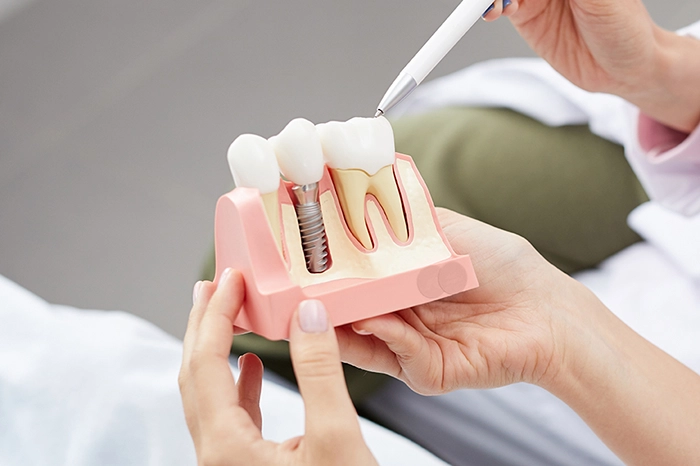 Dentist explaining tooth implantation to a patient on an anatomical model
