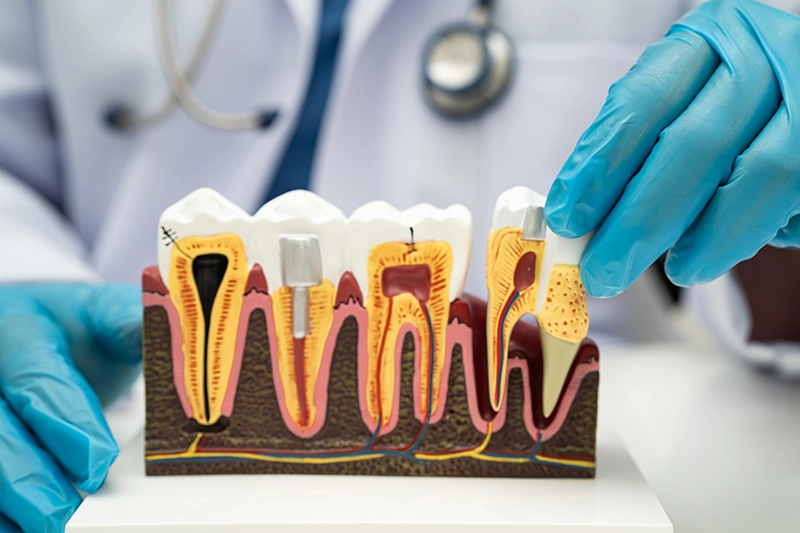 Dentist pulling a tooth out of an anatomical model.